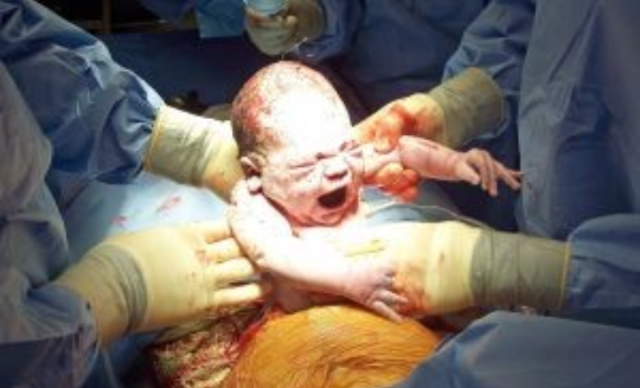 الولادة القيصري