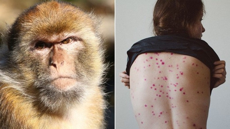 إصابات جدري القرود لا يمكن ايقافها.. علماء يحذرون