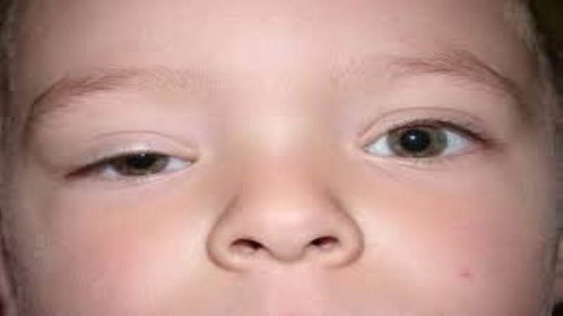 سقوط الجفن.. علامة بعيون طفلك تشير إلى مرض خطير