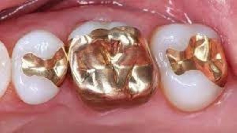 دار الإفتاء: استخدام الذهب في حشو الأسنان جائز شرعا