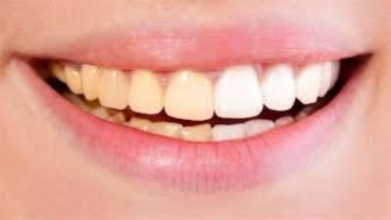 خطوات بسيطة لعلاج اصفرار الأسنان