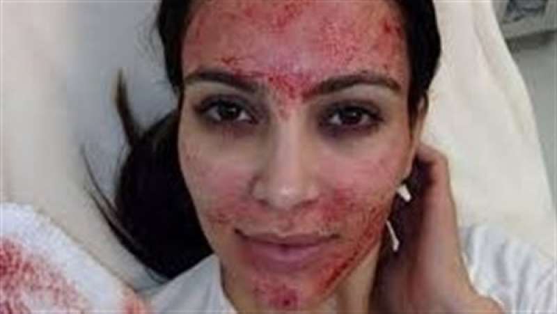 ما هي تقنية مصاص الدماء التجميلية؟