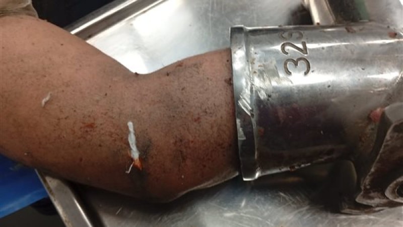 الإسكندرية تشهد معجزة طبية: إنقاذ حياة عامل علقت يده في مفرمة لحوم