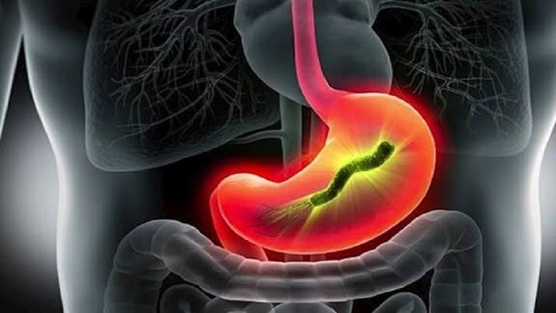 خرافات شائعة عن جرثومة المعدة.. طرق مختلفة للعلاج ونصائح ذهبية للخبراء
