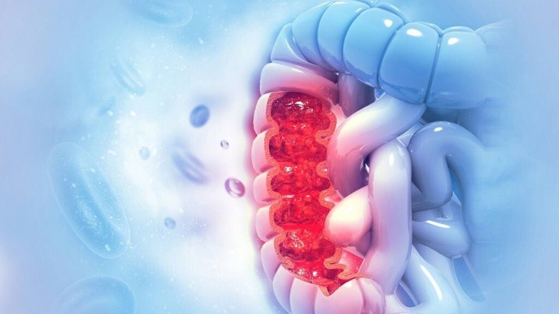 4 علامات تحذيرية مبكرة لسرطان القولون.. فما هي؟