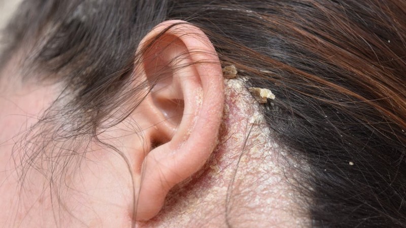 فطريات فروة الرأس الأسباب والأعراض وطرق العلاج الفعالة