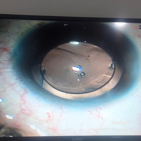 إنقاذ عين مريضة بعد تدخل جراحي دقيق بمستشفى رمد المنصورة