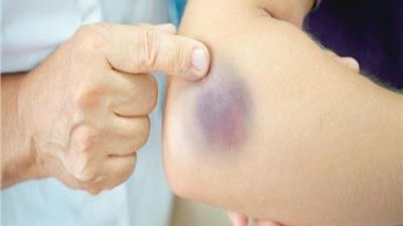 في يومها العالمي.. كل ما تريد معرفته عن مرض الهيموفيليا