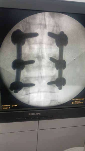 صحة الدقهلية: تدخل جراحي دقيق لتثبيت العمود الفقري ومنع مضاعفات خطيرة بمستشفى ميت غمر المركزي