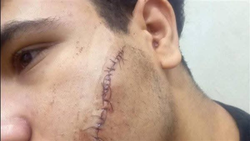 فيه ايه بالظبط في مدارسنا ؟ .. إصابة طالب بـ ١٢ غرزة  داخل لجنة امتحان