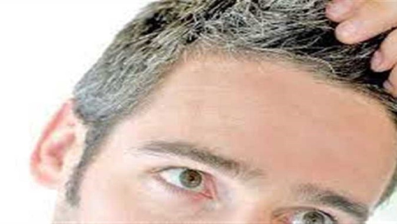 أسباب ظهور الشعر الأبيض مبكرا