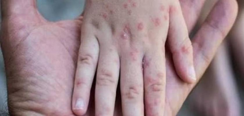 الأمم المتحدة تحذر من انتشار واسع وسريع لمرض جدري الماء في غزة
