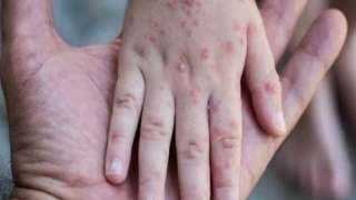 الأمم المتحدة تحذر من انتشار واسع وسريع لمرض جدري الماء في غزة