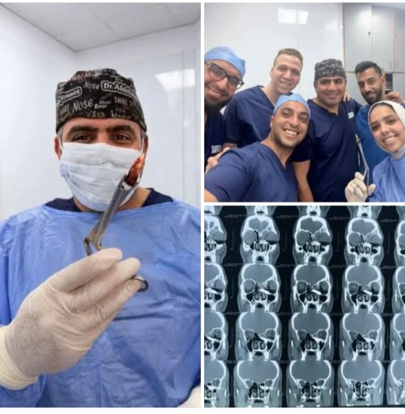 فريق طبي بقصر العيني ينجح في استخراج رصاصة غائرة من وجه مريض بالمنظار الضوئي دون جراحة تقليدية