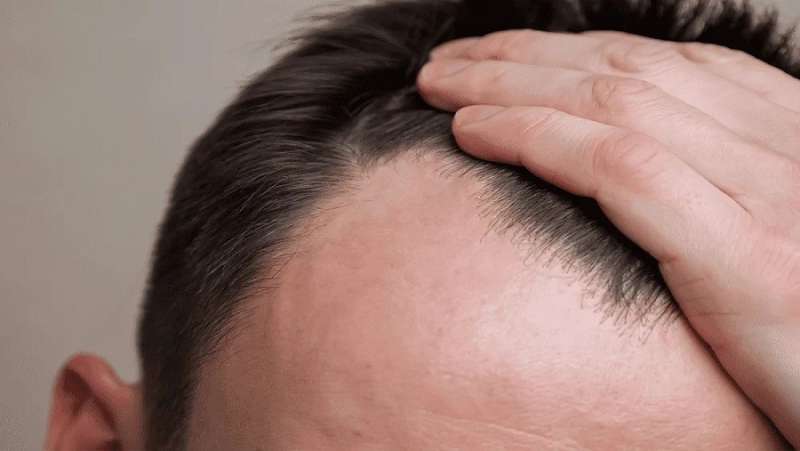 احترس.. أدوية شهيرة تسبب الصلع عند الرجال