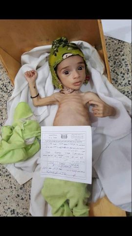 طفلة يمنية تعاني من سوء التغذية