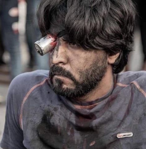 احد المتظاهرين العراقيين وقد اصيب في عينه اليمنى